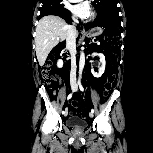 Choledocholiathiasis with normal caliber common bile duct (Radiopaedia 75368-86632 Coronal liver window 68).jpg