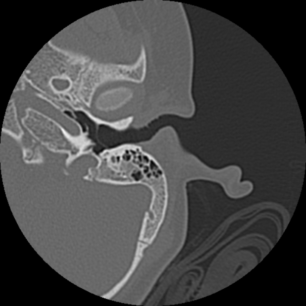 Cholesteatoma (Radiopaedia 73023-83750 Axial Left ear 22).jpg