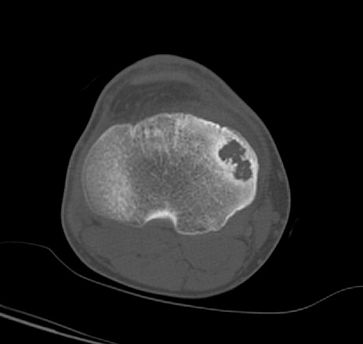 File:Chondroblastoma (Radiopaedia 25725-25890 Axial bone window 1).jpg
