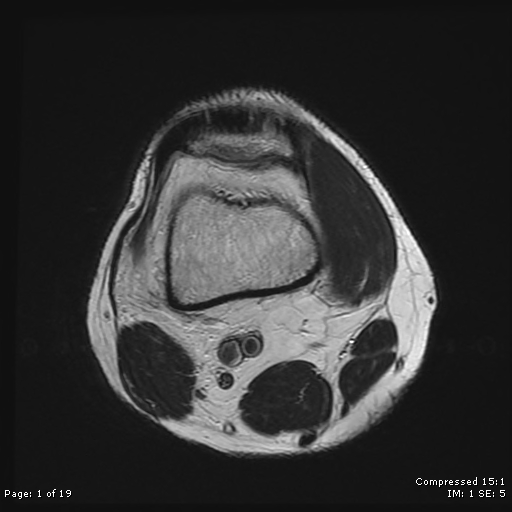 File:Chondroblastoma (Radiopaedia 25725-25891 Axial T2 1).jpg