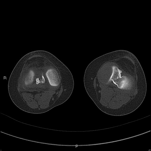 Chondroblastoma (Radiopaedia 62721-71030 Axial bone window 37).jpg
