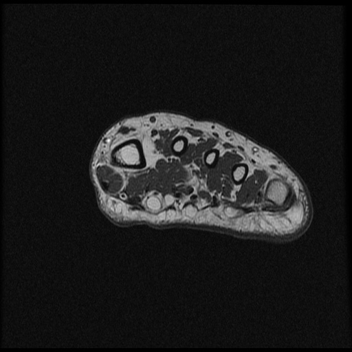File:Chondroblastoma - midfoot (Radiopaedia 64831-73765 Short axis T1 28).jpg