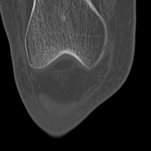 Chondrocalcinosis (Radiopaedia 16275-15955 Coronal bone window 16).jpg