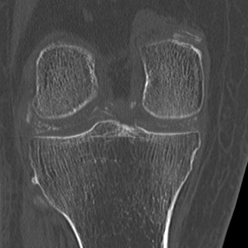Chondrocalcinosis (Radiopaedia 16275-15955 Coronal bone window 38).jpg