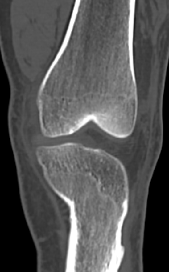Chondrocalcinosis (Radiopaedia 82862-97173 Coronal bone window 28).jpg