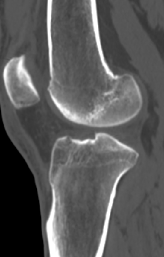 Chondrocalcinosis (Radiopaedia 82862-97173 Sagittal bone window 37).jpg