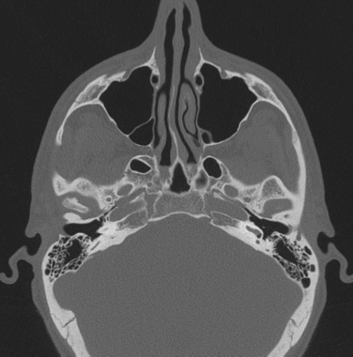 Chondrosarcoma (clivus) (Radiopaedia 46895-51425 Axial bone window 51).png