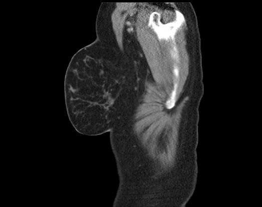 Chondrosarcoma - chest wall (Radiopaedia 65192-74199 B 5).jpg