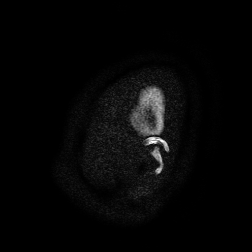 File:Chordoid glioma of third ventricle (Radiopaedia 91612-109340 F 208).jpg