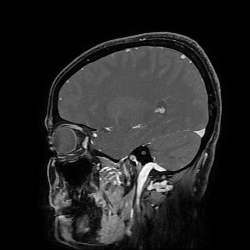 Chordoid glioma of third ventricle (Radiopaedia 91612-109340 F 71).jpg