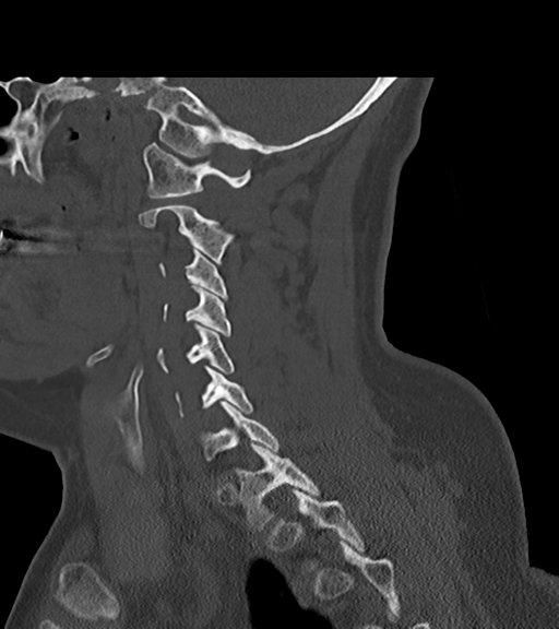 File:Chordoma (C4 vertebra) (Radiopaedia 47561-52188 Sagittal bone window 29).png