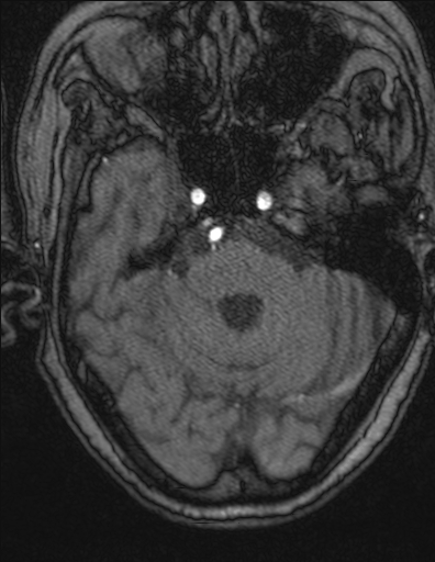 Choroid plexus xanthogranuloma - unilateral (Radiopaedia 85632-101393 Axial TOF 4).jpg