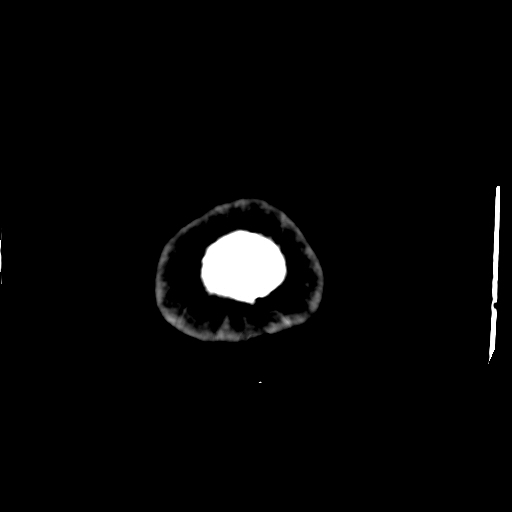 Choroid plexus xanthogranulomas (Radiopaedia 51621-57408 Axial non-contrast 120).jpg