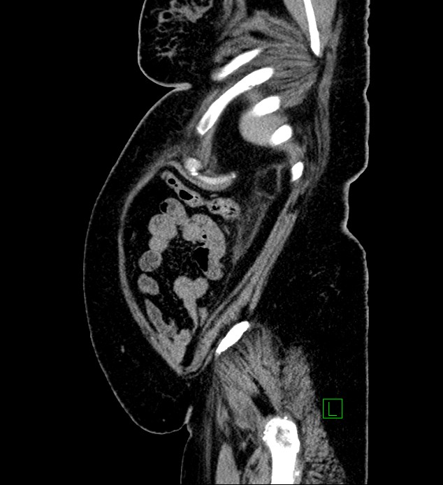 Chromophobe renal cell carcinoma (Radiopaedia 84239-99519 G 19).jpg
