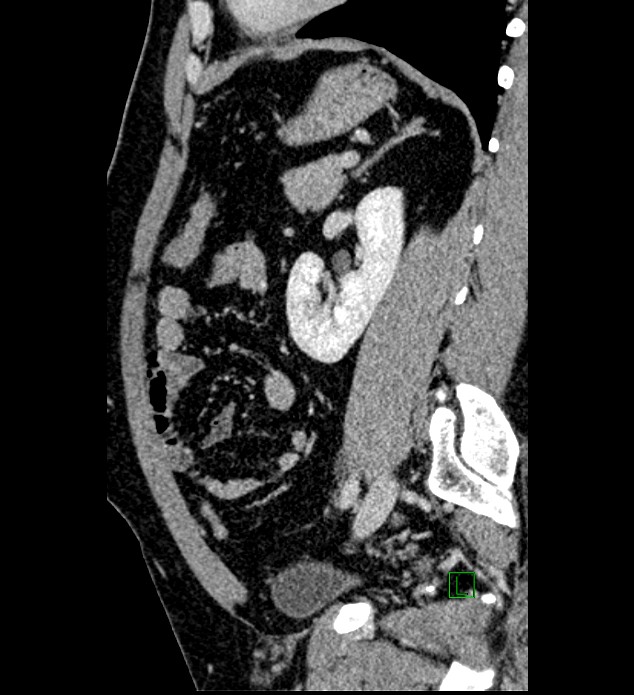 Chromophobe renal cell carcinoma (Radiopaedia 84286-99573 I 61).jpg