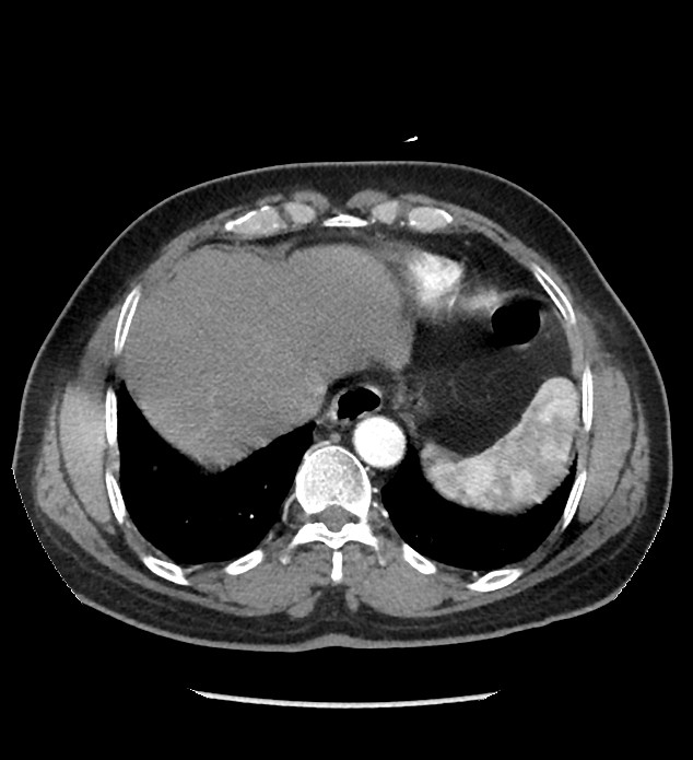 Chromophobe renal cell carcinoma (Radiopaedia 86879-103083 B 19).jpg
