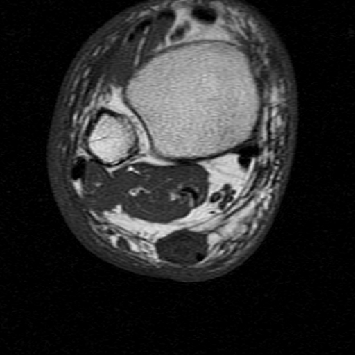 File:Chronic Achilles tendon rupture (Radiopaedia 15262-15100 Axial T1 7).jpg