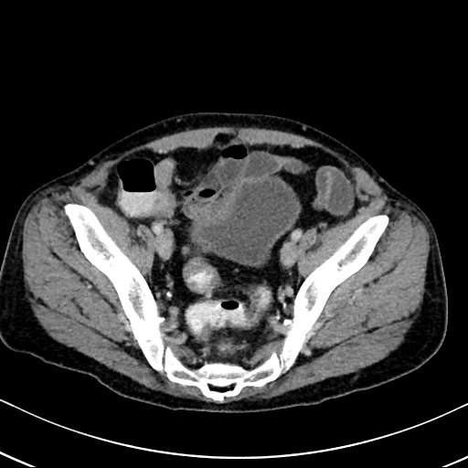 Chronic appendicitis complicated by appendicular abscess, pylephlebitis and liver abscess (Radiopaedia 54483-60700 B 121).jpg