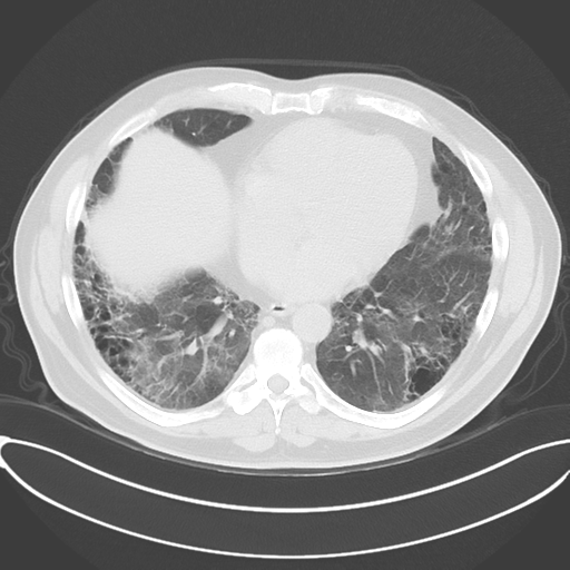 Chronic hypersensitivity pneumonitis (Radiopaedia 48107-52922 Axial lung window 41).png