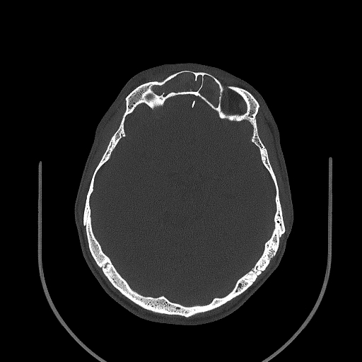 Chronic invasive fungal sinusitis (Radiopaedia 50342-55710 Axial bone window 110).jpg