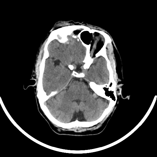 File:Chronic invasive fungal sinusitis with intraorbital and intracranial extension (Radiopaedia 56387-63046 Axial non-contrast 143).jpg