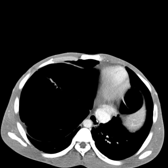 Chronic large bowel pseudo-obstruction (Radiopaedia 43181-46492 A 30).jpg