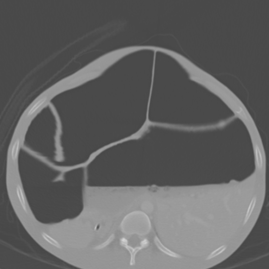 Chronic large bowel pseudo-obstruction (Radiopaedia 43181-46492 Axial bone window 54).jpg