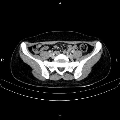 File:Chronic mesenteric nonspecific lymphadenitis (Radiopaedia 84910-100414 B 75).jpg