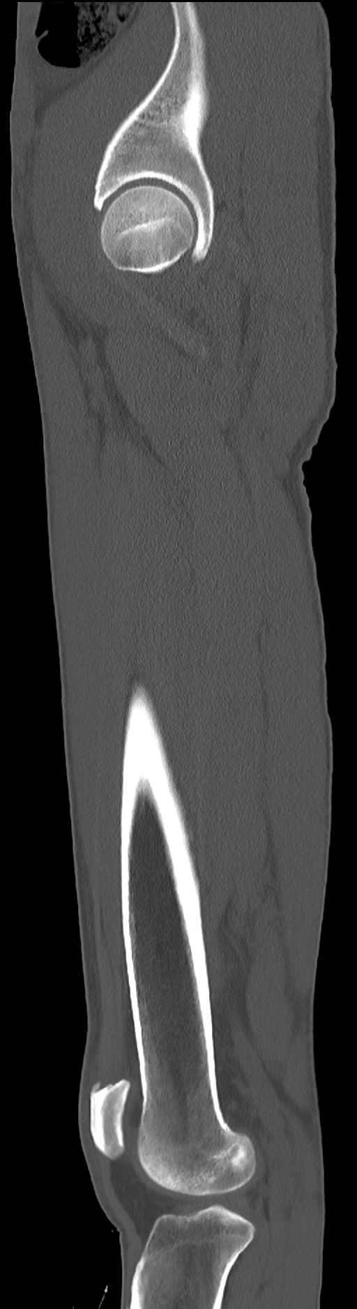Chronic osteomyelitis (with sequestrum) (Radiopaedia 74813-85822 C 31).jpg
