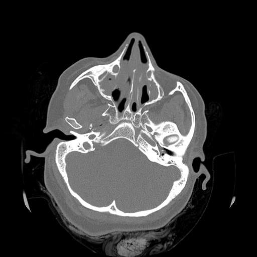Chronic sinusitis with intra-sinus calcification (Radiopaedia 63919-72668 Axial bone window 43).jpg