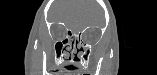 Chronic sphenoidal sinusitis (Radiopaedia 62030-70122 Coronal bone window 72).jpg