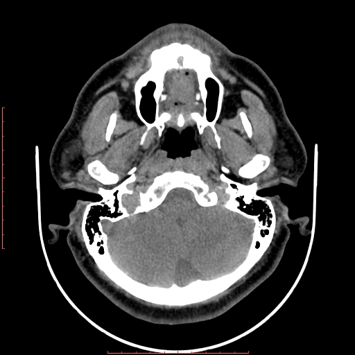 File:Chronic submandibular sialolithiasis (Radiopaedia 69817-79814 Axial non-contrast 23).jpg