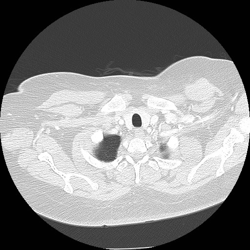 Cicatrisation collapse (Radiopaedia 17405-17089 lung window 10).jpg