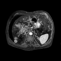 Cirrhosis and hepatocellular carcinoma in the setting of hemochromatosis (Radiopaedia 75394-86594 Axial T1 C+ fat sat 218).jpg