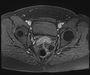 File:Class II Mullerian duct anomaly- unicornuate uterus with rudimentary horn and non-communicating cavity (Radiopaedia 39441-41755 Axial T1 fat sat 92).jpg