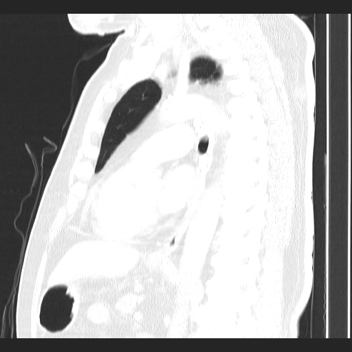 File:Classic complicated silicosis (Radiopaedia 49720-54961 Sagittal lung window 28).jpg