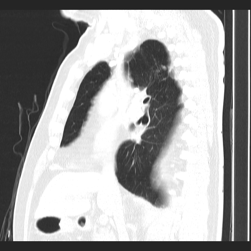 Classic complicated silicosis (Radiopaedia 49720-54961 Sagittal lung window 37).jpg