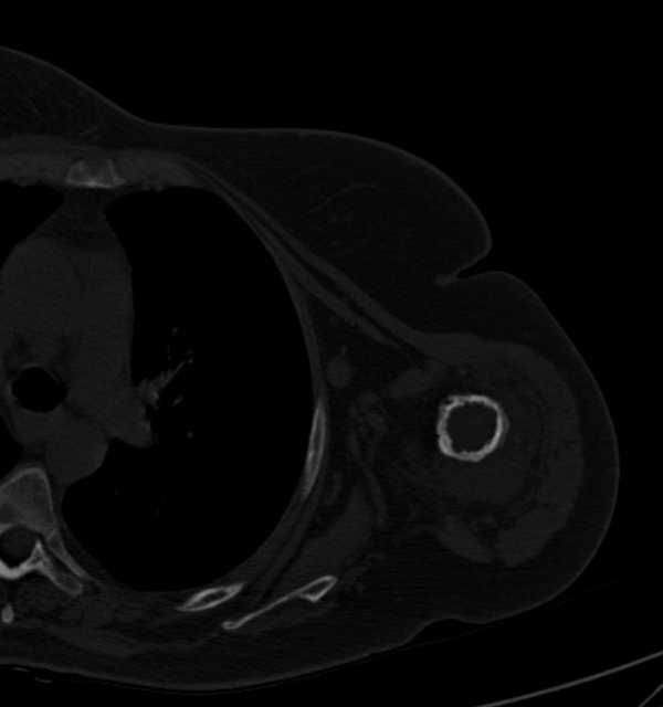 Clear cell chondrosarcoma - humerus (Radiopaedia 63104-71612 Axial bone window 66).jpg