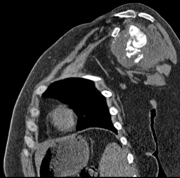 Clear cell chondrosarcoma - humerus (Radiopaedia 63104-71612 D 34).jpg