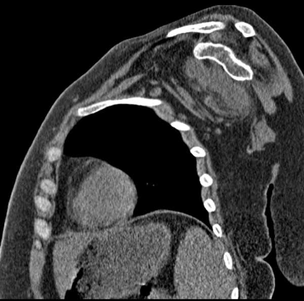Clear cell chondrosarcoma - humerus (Radiopaedia 63104-71612 D 38).jpg
