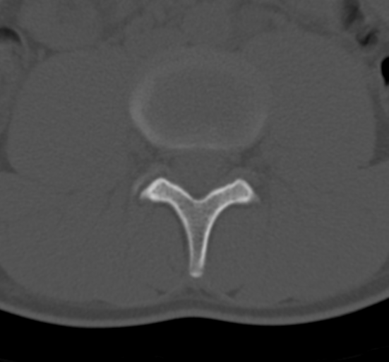 Clear cell meningoma - lumbar spine (Radiopaedia 60116-67691 Axial bone window 43).png