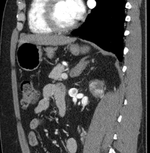 File:Clear cell renal cell carcinoma (Radiopaedia 61449-69393 D 41).jpg