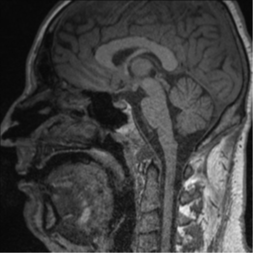 File:Clival chordoma invading the hypoglossal canal (Radiopaedia 48850-53884 Sagittal T1 29).png