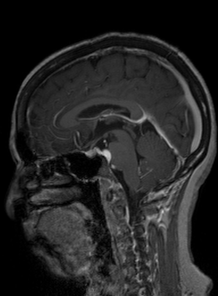 File:Clival meningioma (Radiopaedia 53278-59248 Sagittal T1 C+ 259).jpg