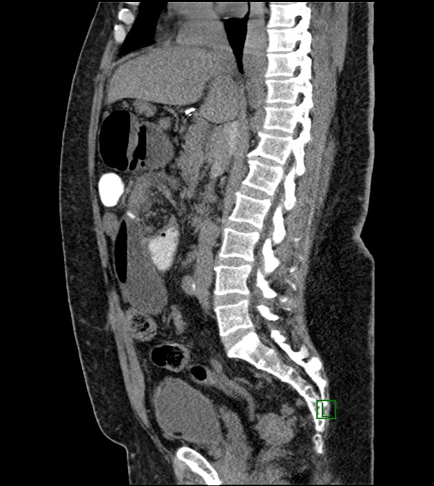 Closed-loop small bowel obstruction-internal hernia (Radiopaedia 78439-91096 C 80).jpg