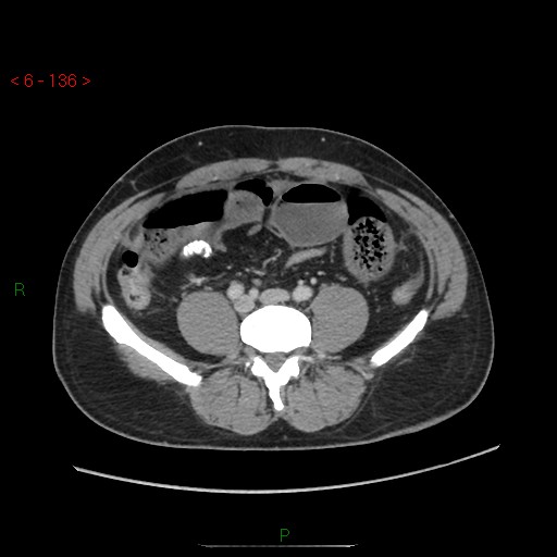 File:Closed loop obstruction and appendicular stump mucocele (Radiopaedia 54014-60163 A 79).jpg
