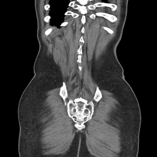 File:Closed loop obstruction due to adhesive band, resulting in small bowel ischemia and resection (Radiopaedia 83835-99023 C 111).jpg