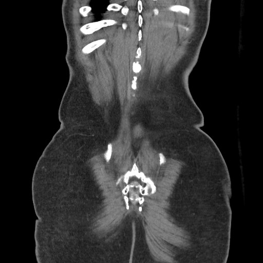 File:Closed loop obstruction due to adhesive band, resulting in small bowel ischemia and resection (Radiopaedia 83835-99023 C 114).jpg
