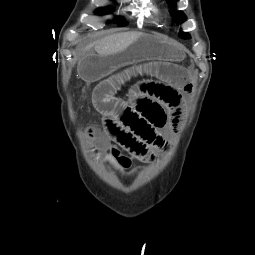File:Closed loop obstruction due to adhesive band, resulting in small bowel ischemia and resection (Radiopaedia 83835-99023 C 25).jpg