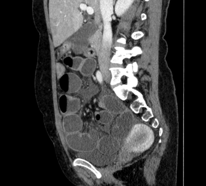 Closed loop small bowel obstruction (Radiopaedia 71211-81508 C 58).jpg